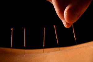 Acupuncture Moxibustion Thérapie traditionnelle Chinoise 0608061955 Montpellier Herault Nimes Gard Languedoc Roussillon Roland Gozlan